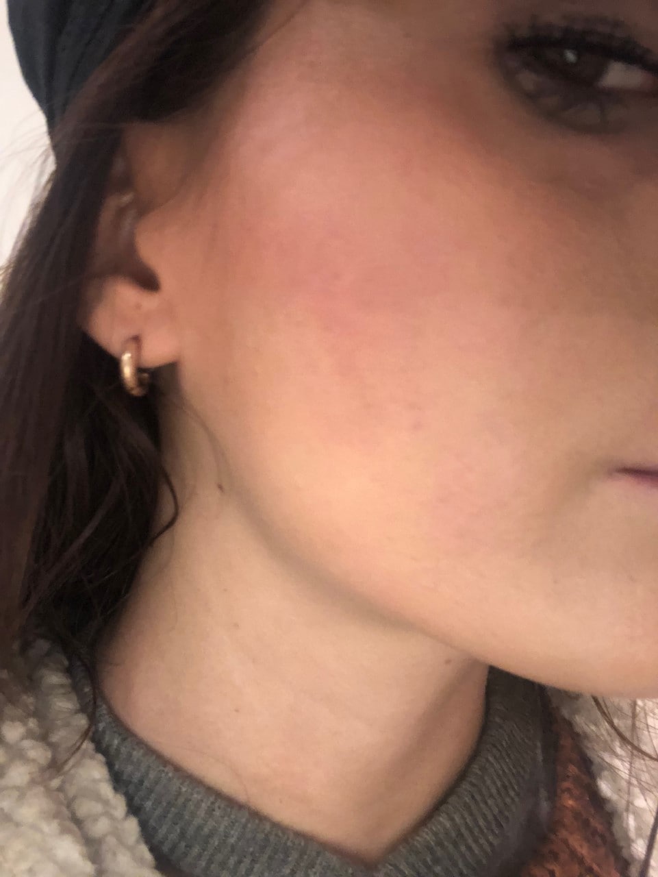Cicatrices acné, laser